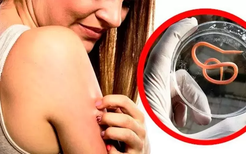 svrbež i iritacija zbog parazita u tijelu