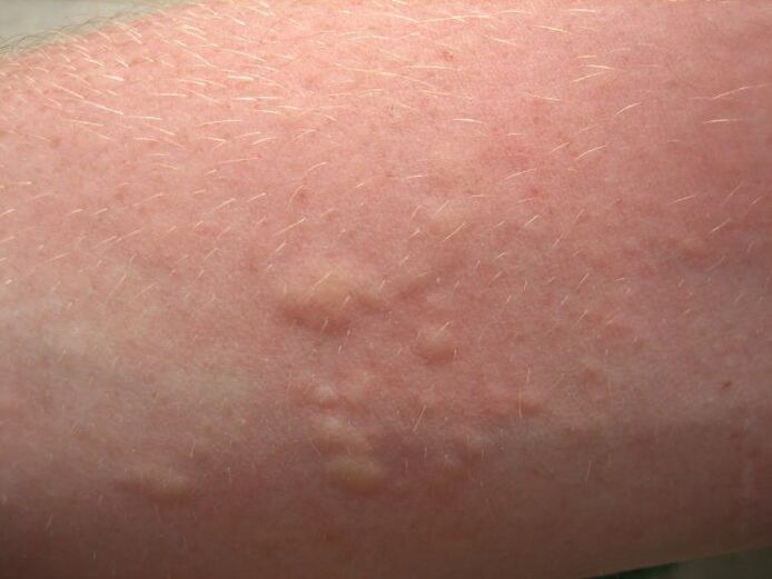 svrbežni alergijski osip na koži može biti simptom ascariaze