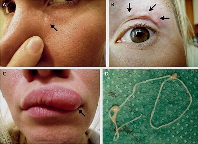 Glavne manifestacije dirofilarijaze na licu