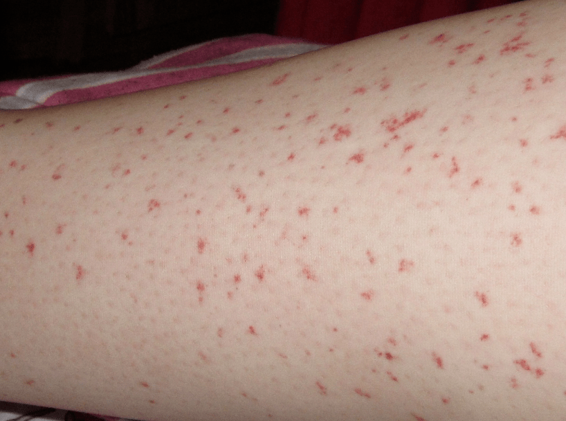 Osip na koži znak je akutne faze infekcije crvima